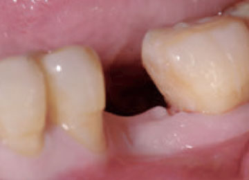 Missing Tooth Before Implant