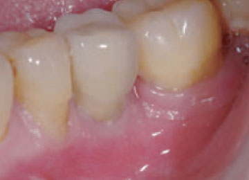 Realistic Teeth Implants Sydney