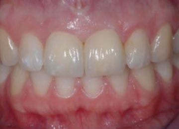 Front Teeth Restoration After Implants