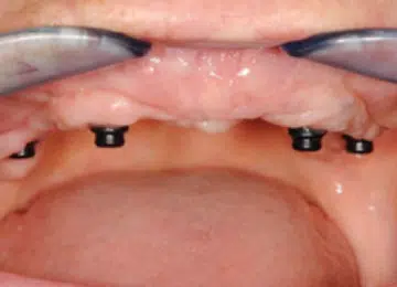 Visible Dental Abutment Teeth Implants