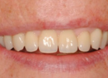 Dental Restoration With Tooth Implants