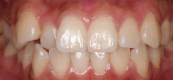 Uneven teeth Before Invisalign