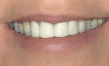 Misaligned Teeth Veneers