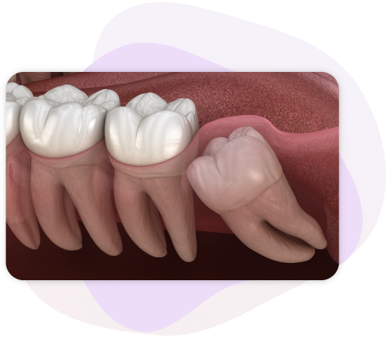 wisdom tooth extraction cost sydney - The Dentist At 70 Pitt Street