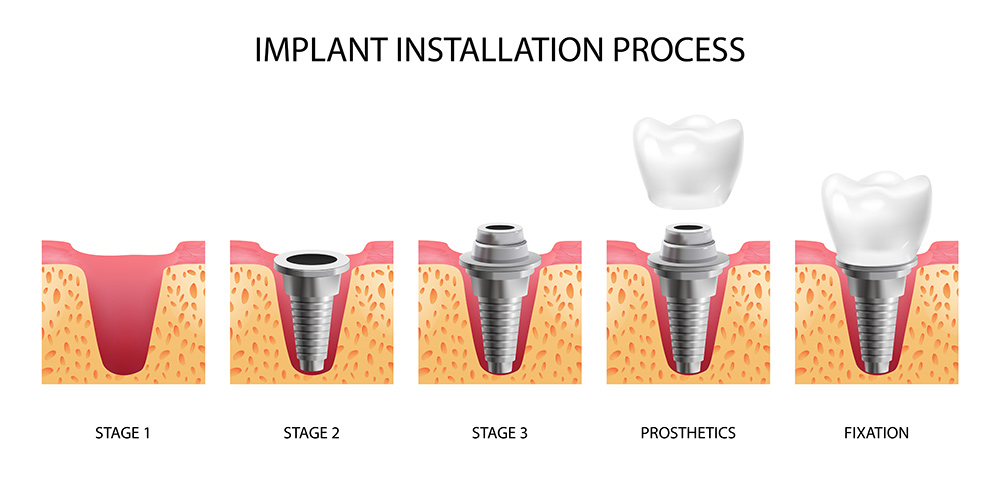 What You Should Know About Dental Implants