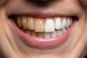 Foods That Stain Teeth | What Foods Stain Teeth | Dental Care